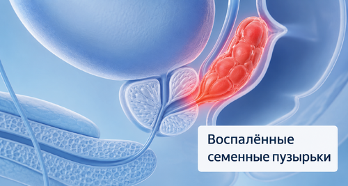 Везикулит (Сперматоцистит)