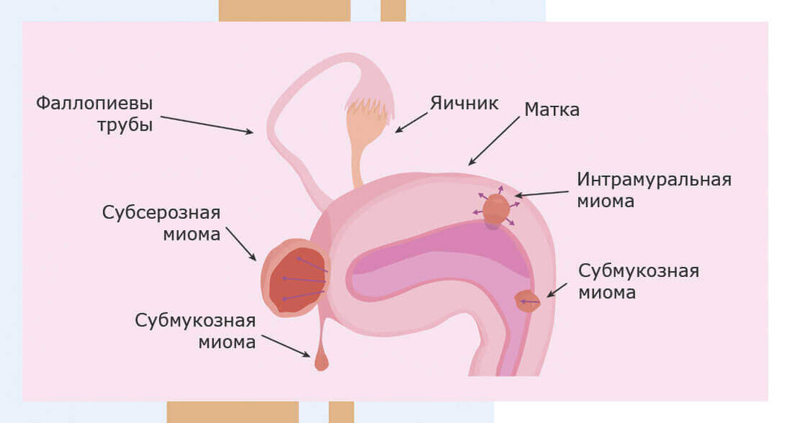 Занятие Сексом При Миоме