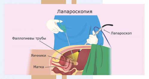 Лапароскопия маточных труб