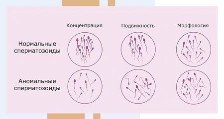 Нормальные и аномальные сперматозоиды. Альтравита.