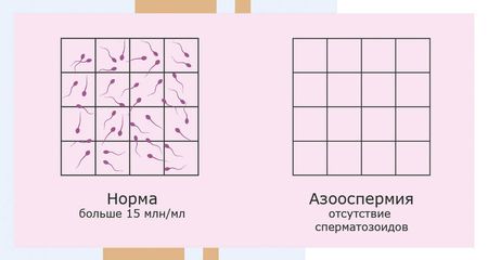 Азооспермия. Альтравита.