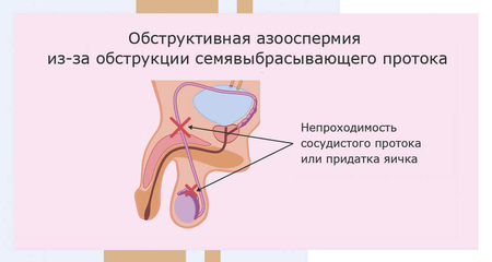 Обструктивная азооспермия. Альтравита.