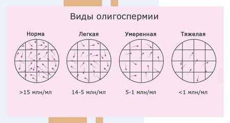Олигозооспермия. Альтравита.