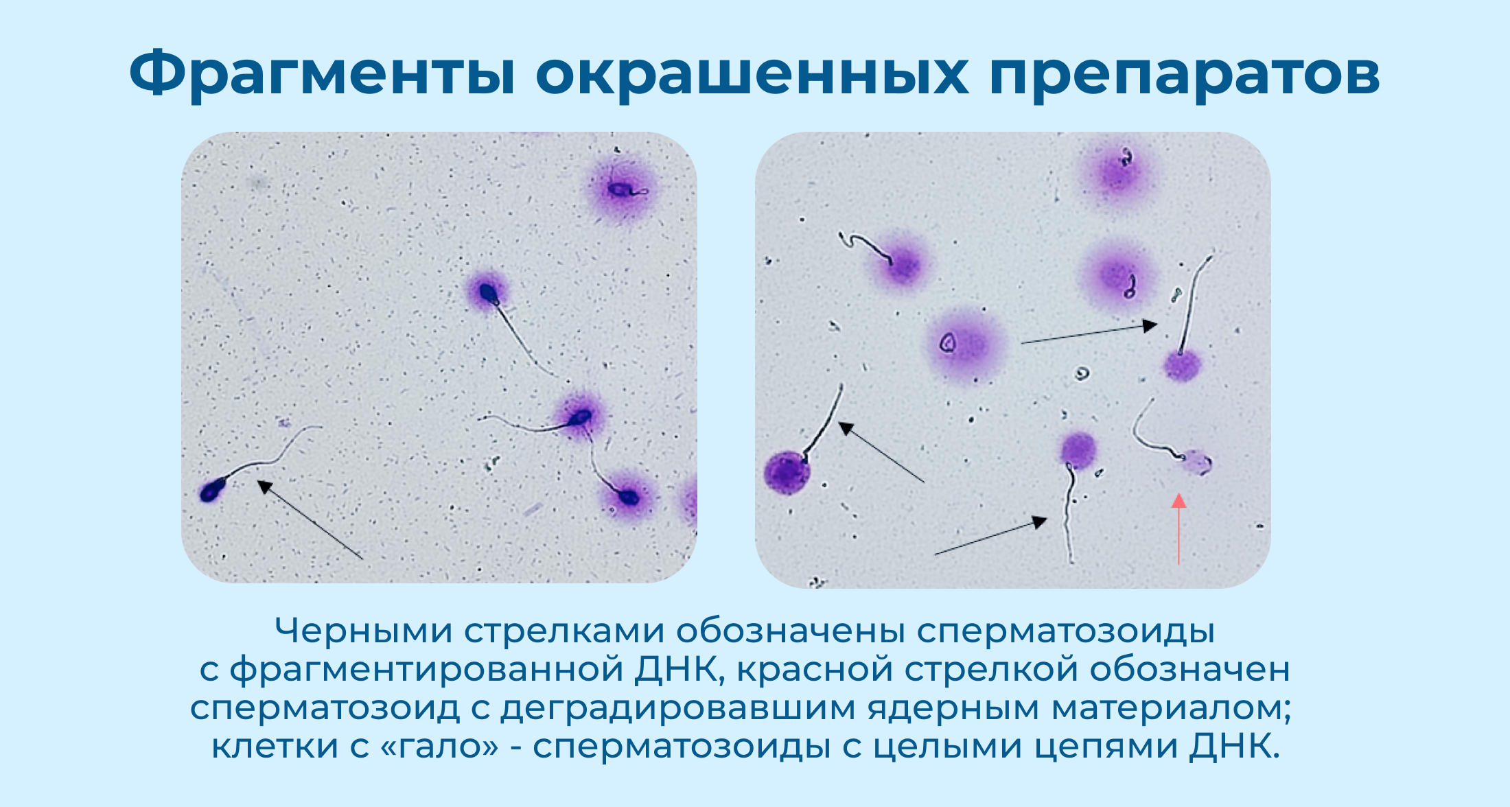 Метод SCD: дисперсия хроматина сперматозоидов - Изображение №3