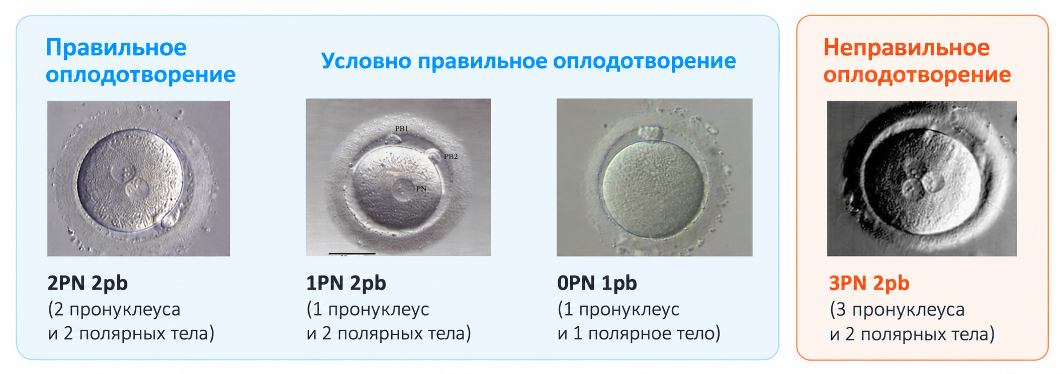 Правильное, условно правильное и неправильное оплодотворение: 2PN, 1PN, 0PN, 3PN