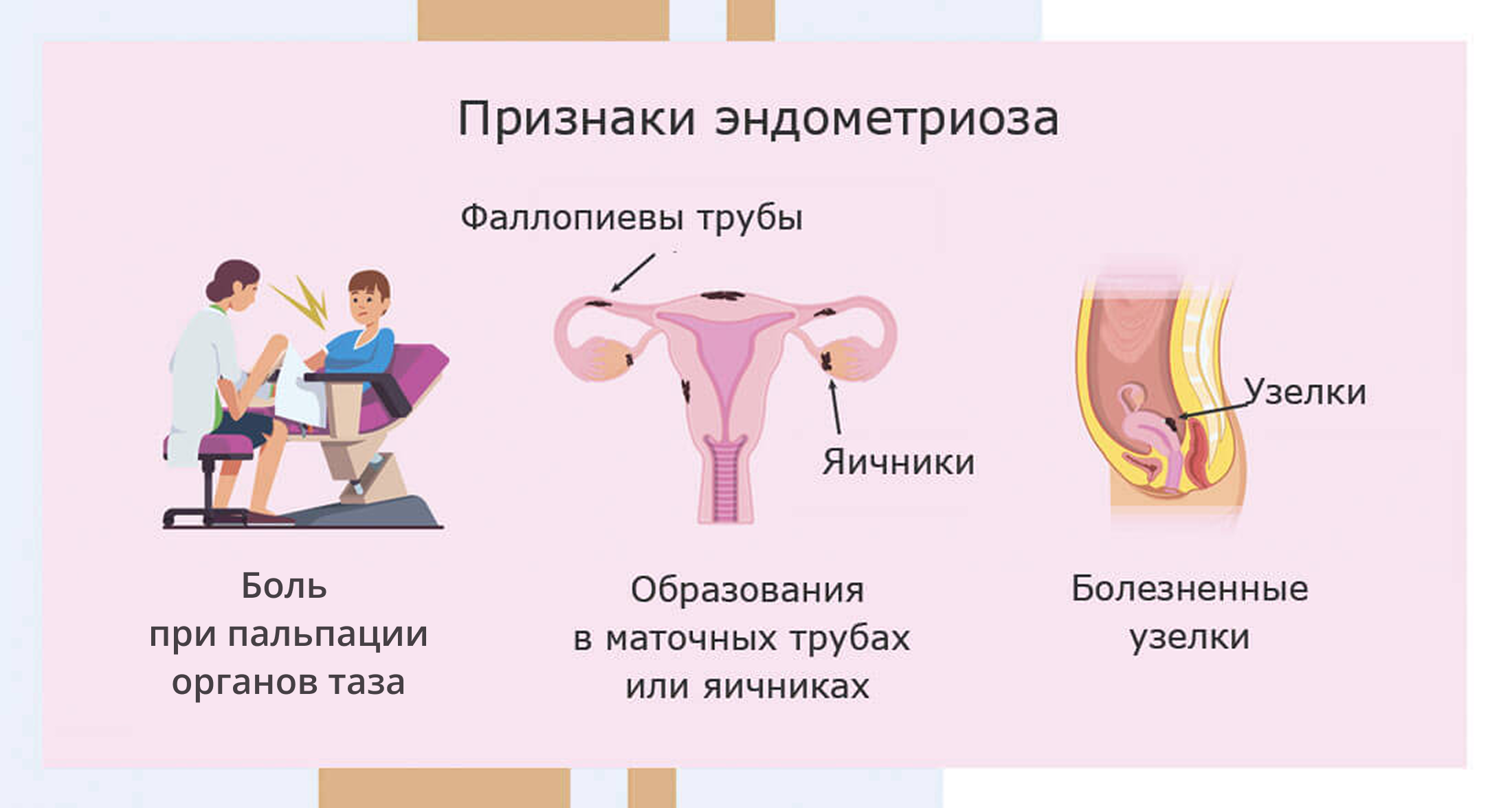 Симптомы эндометриоза - Изображение №4