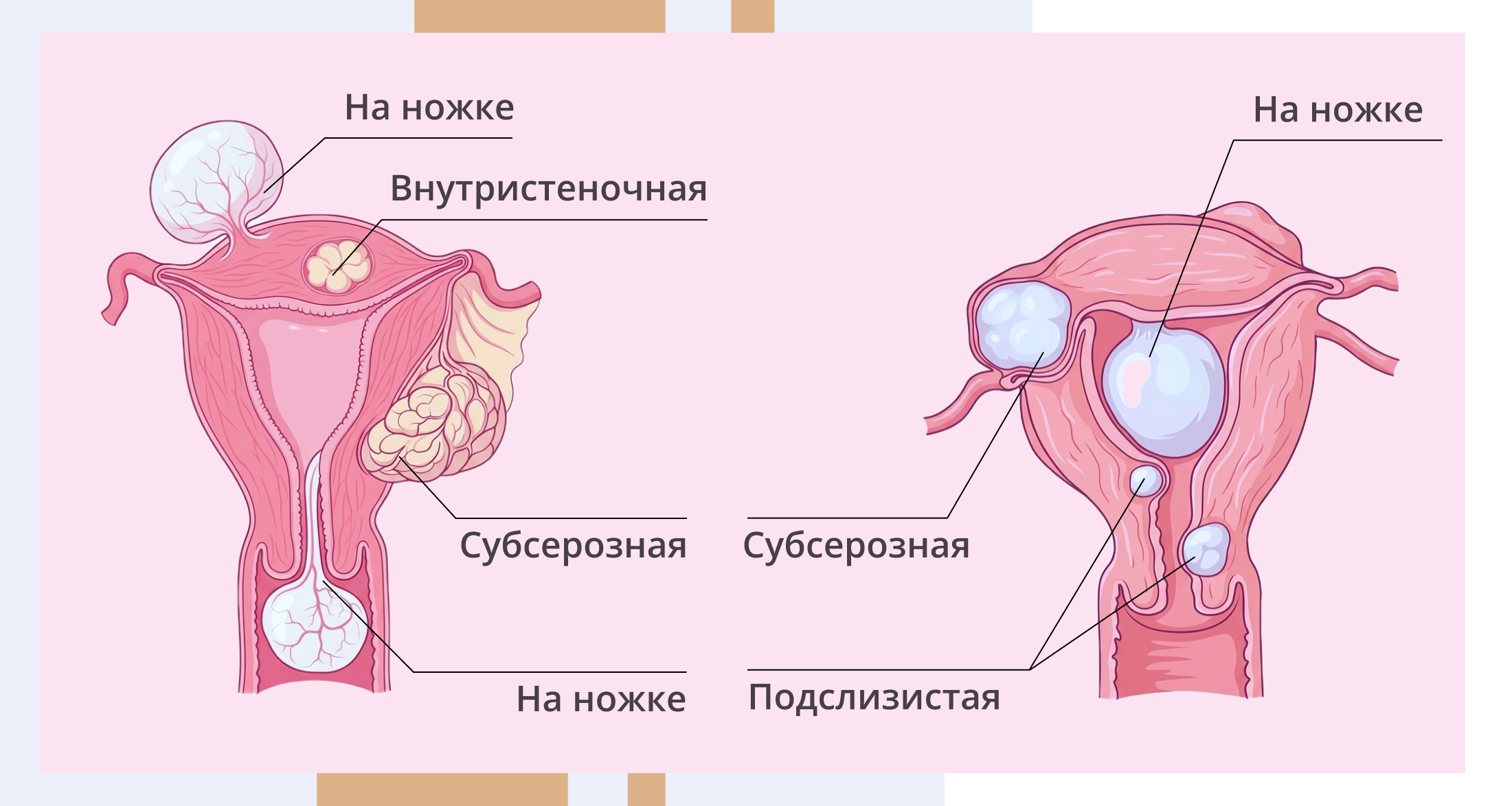 Виды миомы